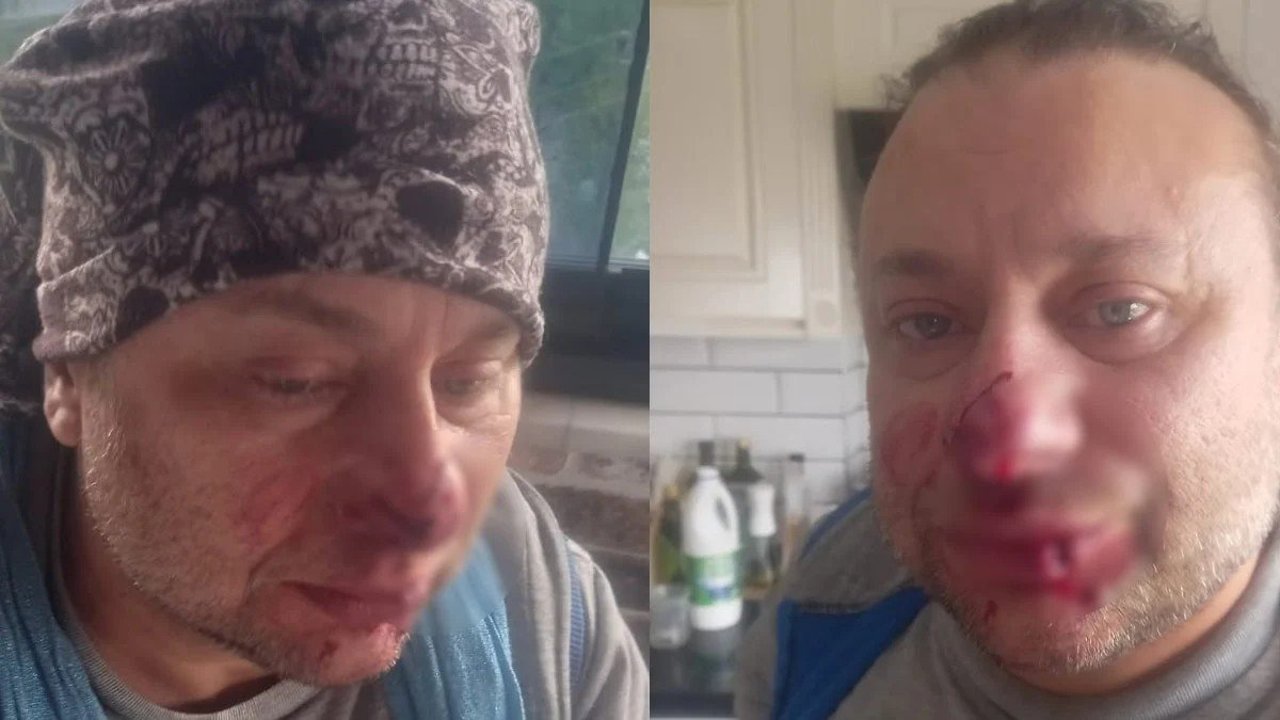 Pitbul saldırısına uğrayan Onur Akay ölümden döndü