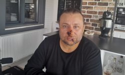 Onur Akay yoğun bakıma kaldırıldı