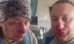 Pitbul saldırısına uğrayan Onur Akay ölümden döndü