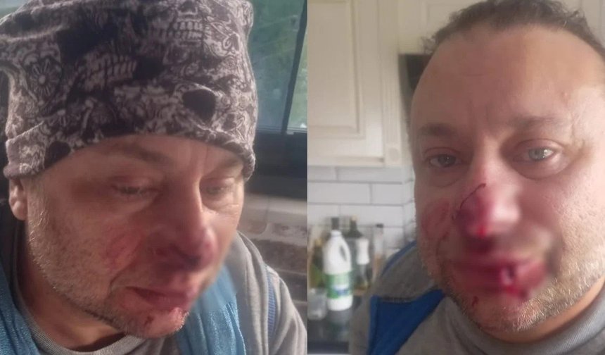 Pitbul saldırısına uğrayan Onur Akay ölümden döndü